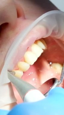 Yakın plan kadın dişçiliği diş fırçalama plaket taşlarını temizleme tükürük püskürtücüsünü ağız aynası kullanarak en yeni teknolojiyi kullanarak su damlaları dökerek temizleme. 