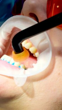 Hastanın yakın dişlerinde fotopolimer lamba kullanarak görülebilir doktor hemşirelik dersi doktoru, lambanın diş gözlüğü eğitimini nasıl aydınlattığını gösteriyor. 