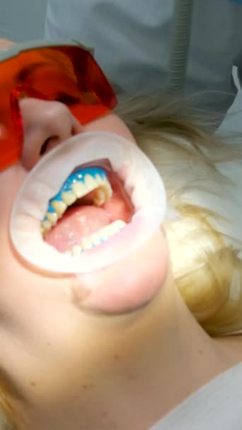 歯茎を漂白剤の作用から隔離する液体コフェルダムオパトラット回転式スプレッダー女性唾液放出器で歯科医師から口を開けて取る — ストック動画