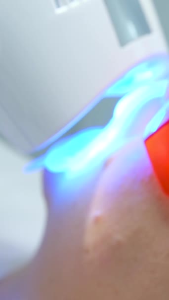除Poluse先进的美白系统外 还配备了牙科紫外激光美白设备 用护目镜对眼睛进行保护 用轻激光和氟乌克兰文尼达2023作发泡美白 — 图库视频影像