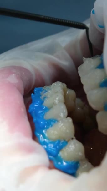 Sıvı Cofferdam Hastaların Dişlerini Beyazlatan Bir Madde Olan Optragat Yayıcının — Stok video