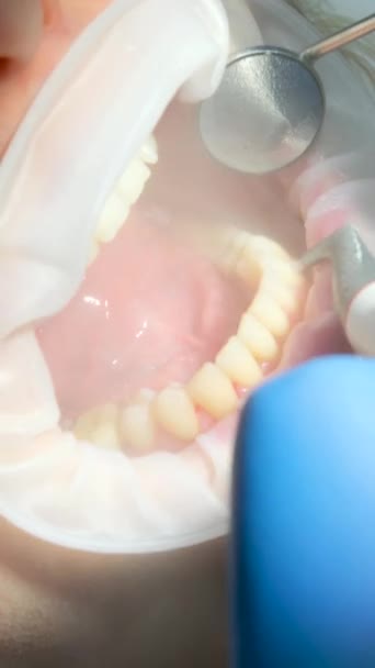 Close Vrouw Tandheelkunde Poetsen Tanden Reinigen Verwijderen Plaque Stenen Speeksel — Stockvideo