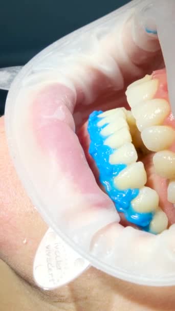 기사보기 의사의 클로즈업 의사가 여성을 보호하기 치아를 하얗게 물약에서 잇몸을 — 비디오