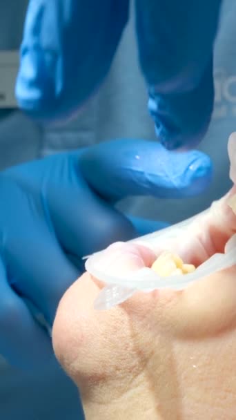 Zubní Lékař Modrých Rukavicích Close Opravuje Ženy Ústa Otevřená Ústa — Stock video