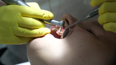 Diş hekimliği ergenliği, sarı eldivenli bir doktor dişçide dişçiye yakın çekim videosu için genç bir kızın dişini doldurur ve dişini yeni teknolojilerle kurutur. modern klinik