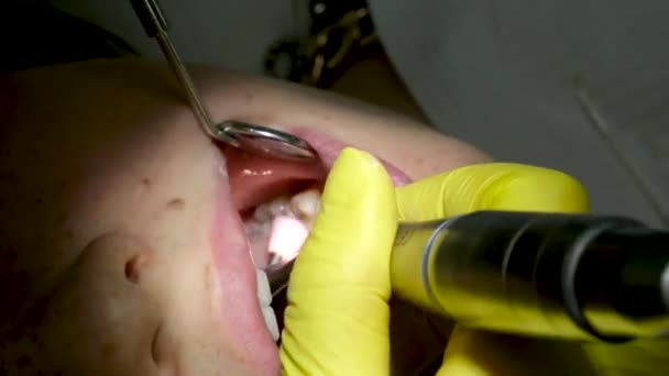 一名戴黄色手套的医生给一名年轻女孩的牙齿充填了一个女牙医的牙齿特写视频 该视频是在牙医用轻型新技术干燥牙齿时拍摄的 现代诊所 — 图库视频影像