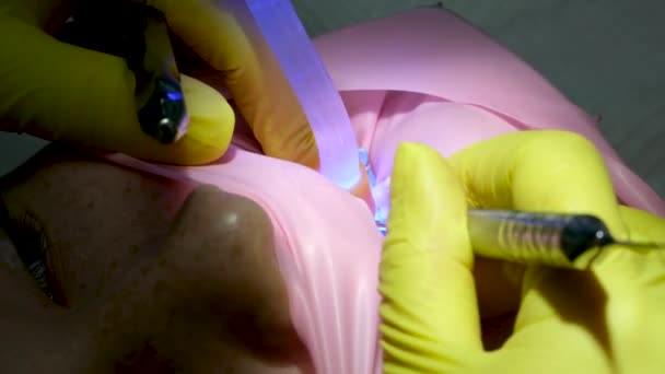 一名戴黄色手套的医生给一名年轻女孩的牙齿充填了一个女牙医的牙齿特写视频 该视频是在牙医用轻型新技术干燥牙齿时拍摄的 现代诊所 — 图库视频影像