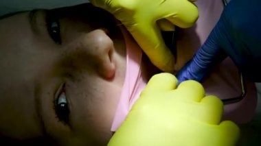 Diş hekimliği ergenliği, sarı eldivenli bir doktor dişçide dişçiye yakın çekim videosu için genç bir kızın dişini doldurur ve dişini yeni teknolojilerle kurutur. modern klinik