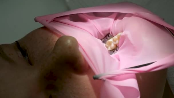 Οδοντιατρική Εφηβεία Ένας Γιατρός Κίτρινα Γάντια Γεμίζει Ένα Δόντι Ενός — Αρχείο Βίντεο
