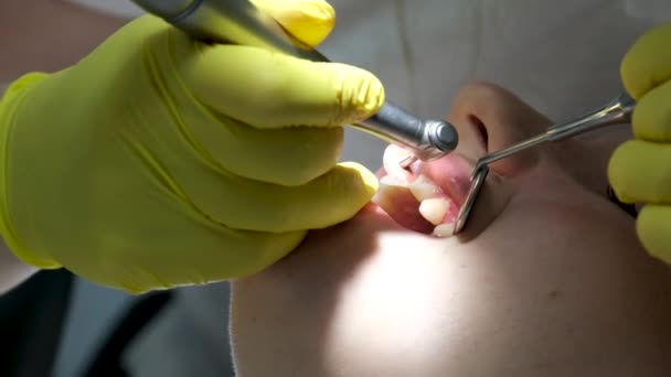 黄色い手袋の歯科医が若い女の子の歯を埋めます 歯医者で歯医者を閉じるビデオ 明るい新しい技術で歯を乾かす 現代クリニック — ストック動画