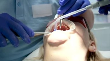Bir diş kliniğinde diş temizliği, taş ve plaket çıkarmak, bir kadınla çalışan genç uzmanlar, salya püskürtücüsünü temizlemek, tükürük emmek, dişlere boya sürmek,