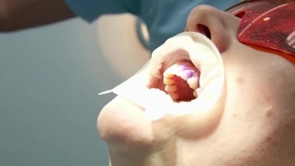 Limpieza Dental Profesional Una Clínica Dental Extracción Piedras Placa Jóvenes — Vídeo de stock