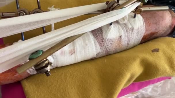 Bacağındaki Yaralar Kemiğe Iğneler Saplanmış Gerçek Insanlar Alt Uzvu Kesilmiş — Stok video