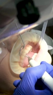 En son teknoloji temizliği ve diş beyazlatma hemşiresi ve doktor genç bir dişçinin dişlerini tedavi ediyor. Genç bir kızın maskeleri eldivenleri temizleme temizliği yapıyor. Klinikteki en son cihaz.