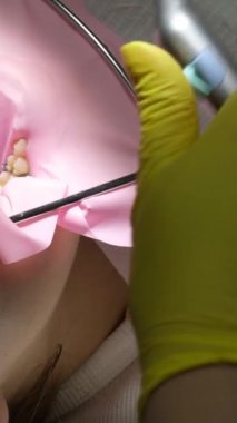 Diş hekimliği ergenliği, sarı eldivenli bir doktor dişçide dişçiye yakın çekim videosu için genç bir kızın dişini doldurur ve dişini yeni teknolojilerle kurutur. modern klinik