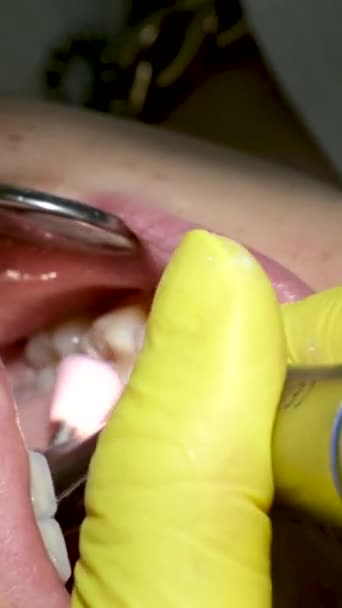 Adolescência Odontológica Médico Luvas Amarelas Enche Dente Uma Jovem Para — Vídeo de Stock