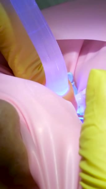 Подростковая Стоматология Врач Желтых Перчатках Заполняет Зуб Молодой Девушки Женщины — стоковое видео
