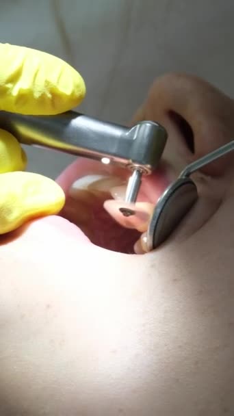 Stomatologia Dojrzewanie Lekarz Żółtych Rękawiczkach Wypełnia Ząb Młodej Dziewczyny Dla — Wideo stockowe