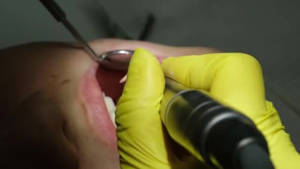 Ung Kvinnlig Tandläkare Mottagning Ortodontisten Ersättning Tandställning Polering Gelbindning Högkvalitativ — Stockvideo