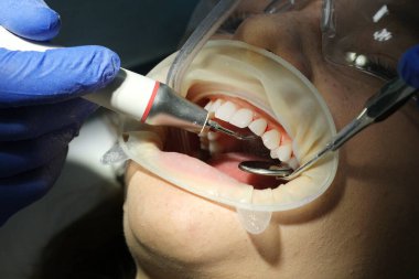 Dişçi seramik kaplama ve kaplama takmadan önce kadın için intraoral tarama yapıyor. Ortodontist elinde çene ve ağız için 3D tarayıcı tutuyor. Prosthodontikler 