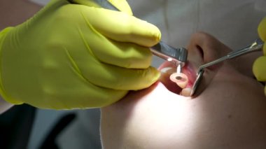Diş hekimi ve asistanı hastayı ışıkla ameliyat ediyor. Hasta ağzına doğru parlıyor. Yüksek kalite 4k görüntü