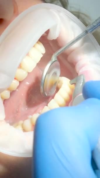 口腔ミラーを使用して歯垢石唾液エジェクターを除去歯を磨く密接な女性歯科用ブラッシング最新の技術サンドブラスターゴーグル水が両側にこぼれ落ちる口の拡大 — ストック動画