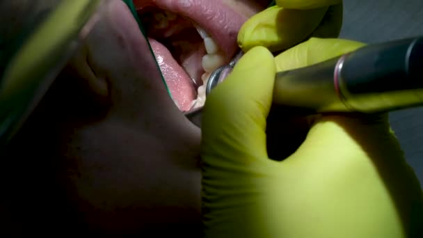 女牙医为病人安装支架 慢动作效果 高质量的4K镜头 — 图库视频影像