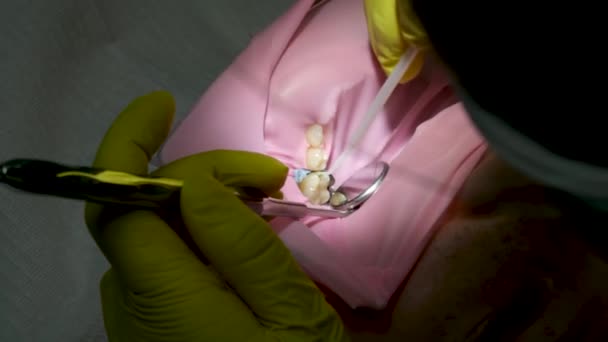 歯科医院の歯科医およびアシスタントの鋭い歯 ゴムダムを着用し 歯科治療を受ける 認識できない女性患者さんのクローズアップショット 高品質の4K映像 — ストック動画