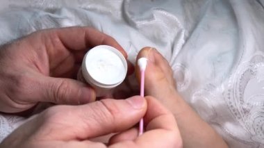 Su nasırı, ayak parmağı su toplamış, yapışkan bantla yapıştırılmış, çinko merhemle yayılmış, tedavi, sıkı ayakkabılar, rahatsızlık, acı, hastalık. Ayak pedikürü evde. Erkek elleri yakın plan