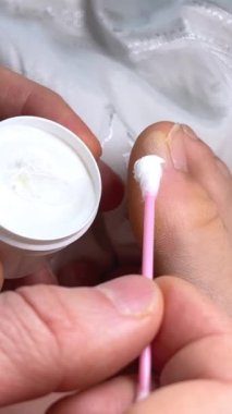 Su nasırı, ayak parmağı su toplamış, yapışkan bantla yapıştırılmış, çinko merhemle yayılmış, tedavi, sıkı ayakkabılar, rahatsızlık, acı, hastalık. Ayak pedikürü evde. Erkek elleri yakın plan