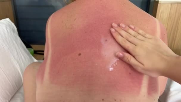日焼けのクローズアップビューは女性の背中を示します 日焼け後に赤みを帯びたかゆみのある女性 高品質の4K映像 — ストック動画
