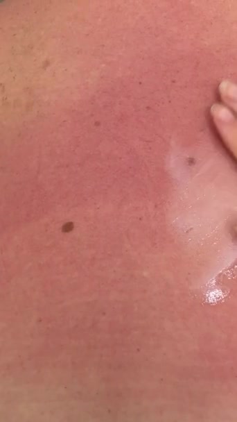 Die Nahaufnahme Eines Sonnenbrandes Markiert Den Rücken Der Frauen Frau — Stockvideo