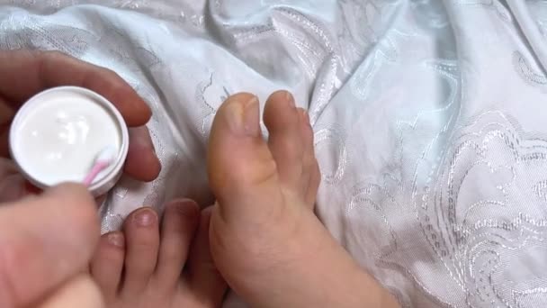 傷ついたつま先を見せている女性 湿疹の複数の混乱したブリスターの後の女性の皮膚に巨大な傷 急性乾癬 化学刺激 アレルギー反応 女性の足の皮膚病 — ストック動画