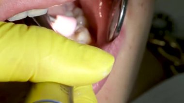 Diş hekimliği ergenliği, sarı eldivenli bir doktor dişçide dişçiye yakın çekim videosu için genç bir kızın dişini doldurur ve dişini yeni teknolojilerle kurutur. modern klinik