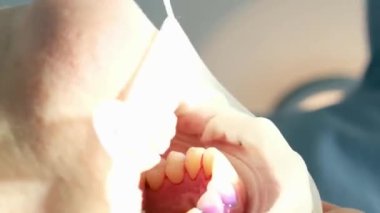 Bir diş kliniğinde diş temizliği, taş ve plaket çıkarmak, bir kadınla çalışan genç uzmanlar, salya püskürtücüsünü temizlemek, tükürük emmek, dişlere boya sürmek,