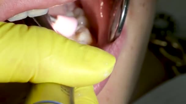 Οδοντιατρική Εφηβεία Ένας Γιατρός Κίτρινα Γάντια Γεμίζει Ένα Δόντι Ενός — Αρχείο Βίντεο