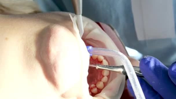 Limpieza Dental Profesional Una Clínica Dental Extracción Piedras Placa Jóvenes — Vídeo de stock