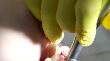 Diş hekimliği ergenliği, sarı eldivenli bir doktor dişçide dişçiye yakın çekim videosu için genç bir kızın dişini doldurur ve dişini yeni teknolojilerle kurutur. modern klinik