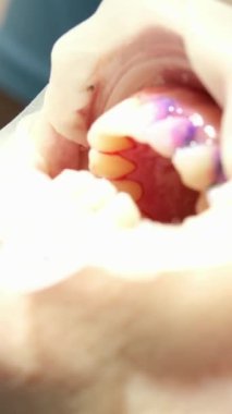 Diş Hekimi Diş Kliniği Çıkarma Prosedürü: Diş Hekimi Diş Anahtarı. Ultra Yüksek Çözünürlük. UltraHD,