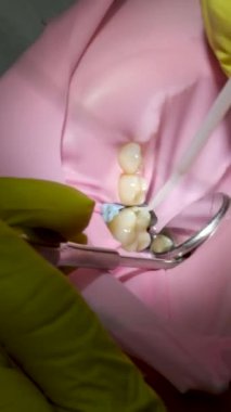 Diş hekiminde dişçi ve asistan. Kauçuk baraj takan ve diş tedavisi gören tanınmayan bir kadının yakın çekimi. Yüksek kalite 4k görüntü