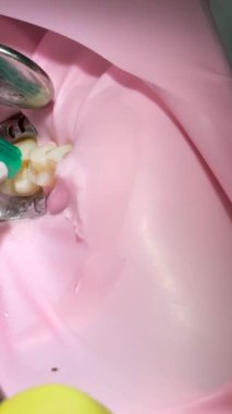 Modern klinikte diş hekiminin diş dolgusu görüntülerini kapatın. Sağlığa. Sabırlı ol. Prosedür. Yüksek kalite 4k görüntü