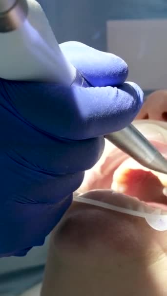 Accesorii Pentru Tratamentul Dentar Procesul Tratament Pacientului Înregistrare Înaltă Calitate — Videoclip de stoc