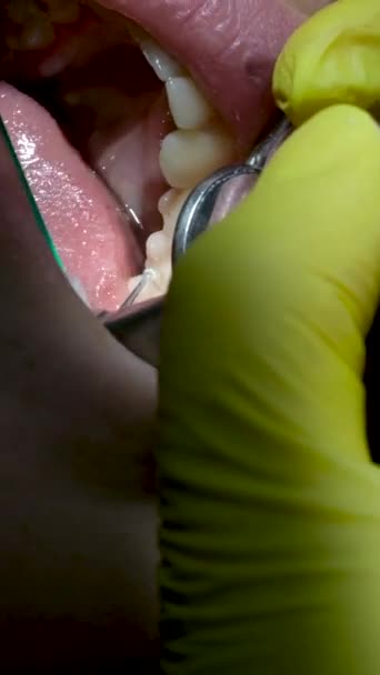 Γυναικεία Οδοντιατρική Ενστικτώδη Ίχνη Στον Ασθενή Κοντινό Πλάνο Εφέ Αργής — Αρχείο Βίντεο