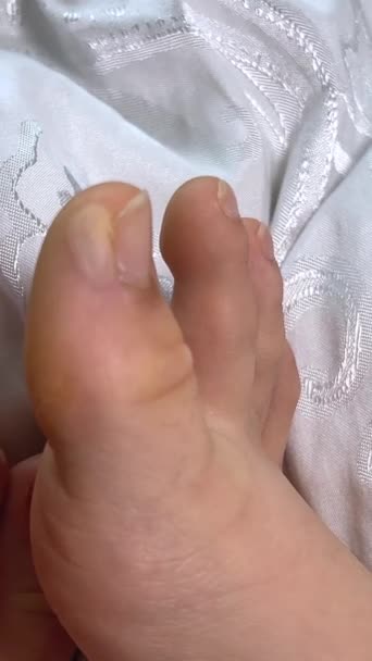 Woman Showing Her Damaged Toes Huge Wound Female Skin Several — Stock Video