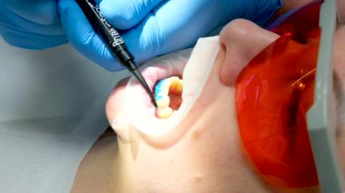 Ultraviyole lambalı diş beyazlatma prosedürü. Klinikteki dişçi kadının portresi. Whiten diş sıvısı Cofferdam izole etmek için. Eylemden sakızlar 