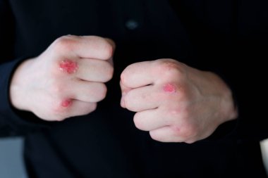 Yumruklarda yaralar. Tıbbi yapıştırıcı. Sporcu boksör el ele yaraları kapatıyor. Boksör yumruk attı.