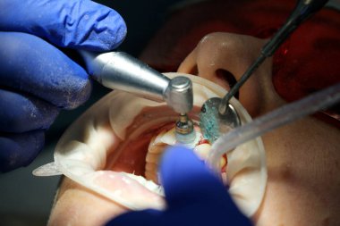 Dişçi dolgusu. Kadın dişçi, dişçi kliniğinde genç kız hastaların dişlerini muayene ediyor. Bir kaşif kullanarak dişleri sondajlayan doktor çürük tedavisi ve kontrol için