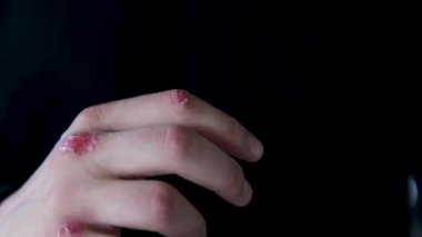 Ellerindeki yaraları temizle. Macro shot, Adam cımbızla bir saç koparır kanlı deriden statik atış