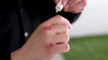 Boxer ellerindeki enfeksiyon kapmış bir çocuğa merhem sürüyorum. Ebeveyn ya da sağlık uzmanı, merhemi yaraya yaymak için işaret parmağını kullanır ve iyileşmeyi hızlandırır..
