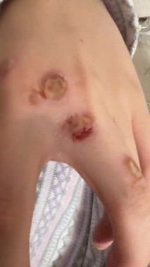 Kimyasal dondurmayla siğil temizleme sonrası pek çok yara izi olan bir el. Ciltte hasar var. Dermatoloji ameliyatı ve tedavisi. Beyaz arka plan. Deri kusurunu çıkarma süreci. Ellerdeki siğilleri sil